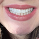 סט 3 קורקטורים להפחתת כתמי שיניים והלבנתן photo review