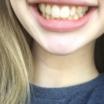 סט 3 קורקטורים להפחתת כתמי שיניים והלבנתן photo review